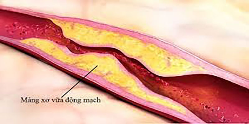 benh-xo-vua-dong-mach