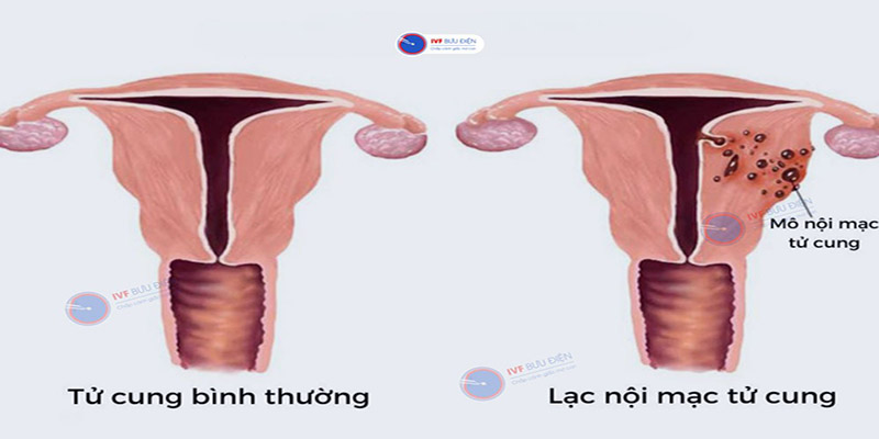 lac-noi-mac-tu-cung-la-gi