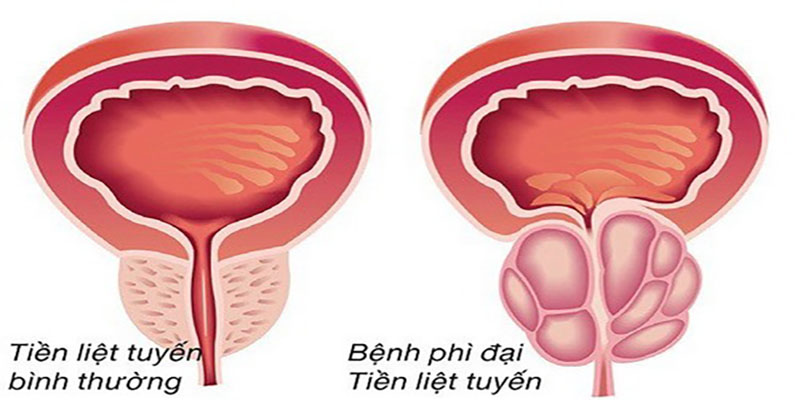 phi-dai-tien-liet-tuyen