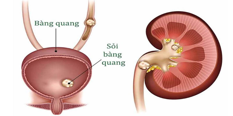 trieu-chung-soi-bang-quang